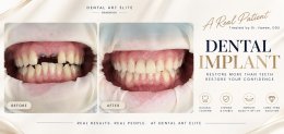 Dental Implant Costs: A Guide to Prices and Treatment Options | Dental Art Elite