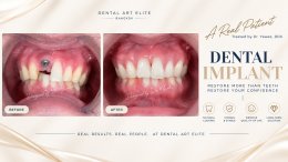 Dental Implant Costs: A Guide to Prices and Treatment Options | Dental Art Elite