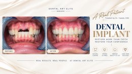 Dental Implant Costs: A Guide to Prices and Treatment Options | Dental Art Elite