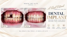 Dental Implant Costs: A Guide to Prices and Treatment Options | Dental Art Elite