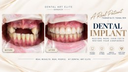 Dental Implant Costs: A Guide to Prices and Treatment Options | Dental Art Elite