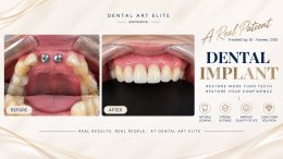 Dental Implant Costs: A Guide to Prices and Treatment Options | Dental Art Elite