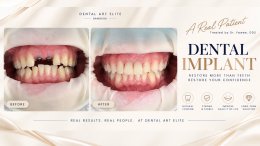 Dental Implant Costs: A Guide to Prices and Treatment Options | Dental Art Elite