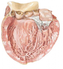 myocarditis กล้ามเนื้อหัวใจขาดเลือด