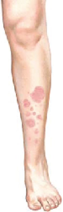  Erythema Nodosum