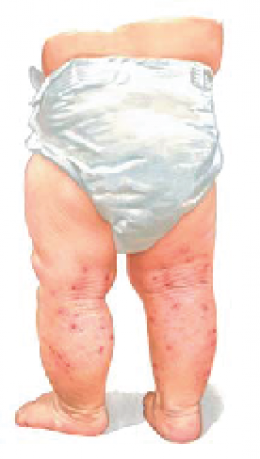 Erythema multiforme โรคผื่นแพ้ยา EM