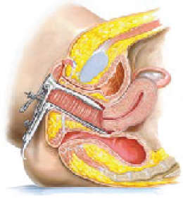 Pap Smear Abnormalities