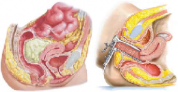 ฝีในอุ้งเชิงกราน Pelvic Abscess