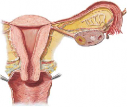 Cervical Polyps 