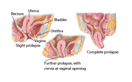 Uterine Prolapse 