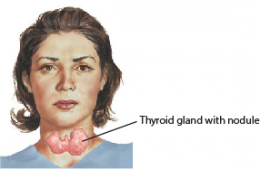 ก้อนที่ต่อมไทรอยด์