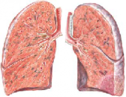 Pulmonary Embolism 