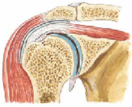 Frozen Shoulder 