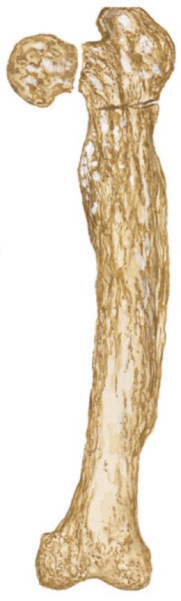 Pagets disease of bone