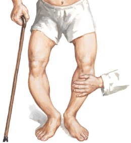 Pagets disease of bone