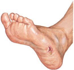 โรคบาดทะยัก (Tetanus)
