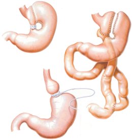 การผ่าตัดลดความอ้วน (Bariatric Surgery)
