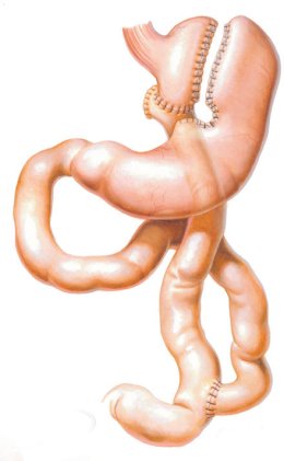 การผ่าตัดลดความอ้วน (Bariatric Surgery)