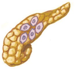 Gastrinoma