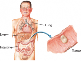 Carcinoid Syndrome