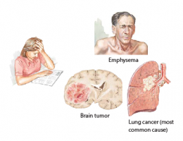 Syndrome of Inappropriate Secretion of Diuretic Hormone 