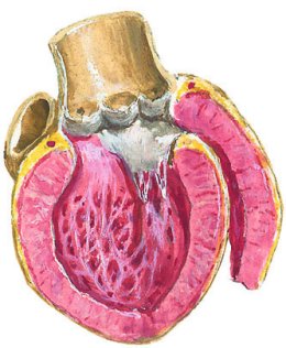 Scleroderma