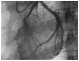 Percutaneous Coronary Intervention