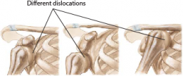 Shoulder Dislocation 