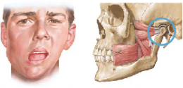 Temporomandibular Joint Syndrome