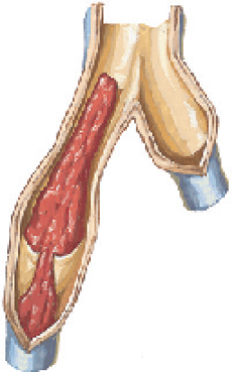 PULMONARY HYPERTENSION