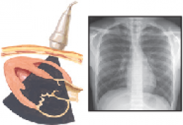 Mitral Valve Disease