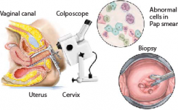 Cervical Dysplasia 