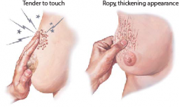 Fibrocystic Breast Changes