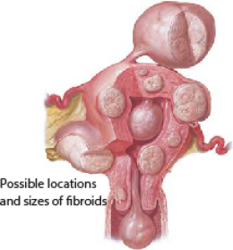 Fibroids 