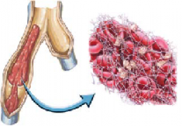 Pulmonary Embolism 