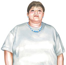 Scleroderma