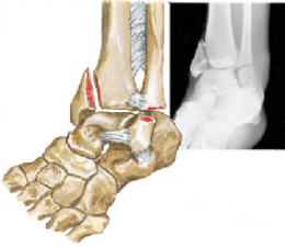 Ankle Fracture 