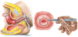 Cervical Dysplasia 