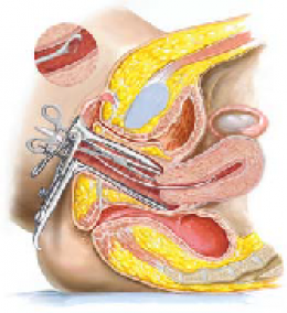 Endometrial Cancer 