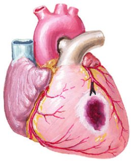 Percutaneous Coronary Intervention