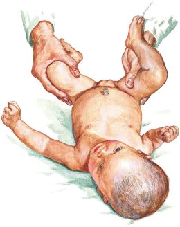 Diaper rash 