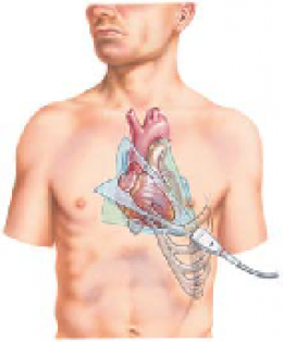  Cardiac Tamponade