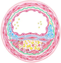 Percutaneous Coronary Intervention