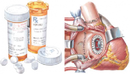 TRICUSPID REGURGITATION