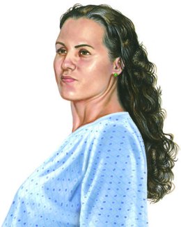 Scleroderma