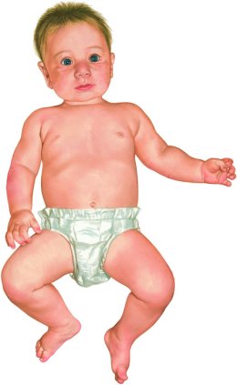 Diaper rash 
