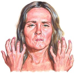 Scleroderma