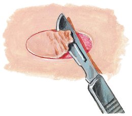 Scleroderma