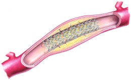 Percutaneous Coronary Intervention