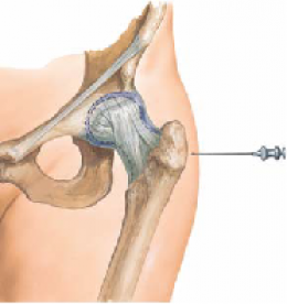 Trochanteric Bursitis 